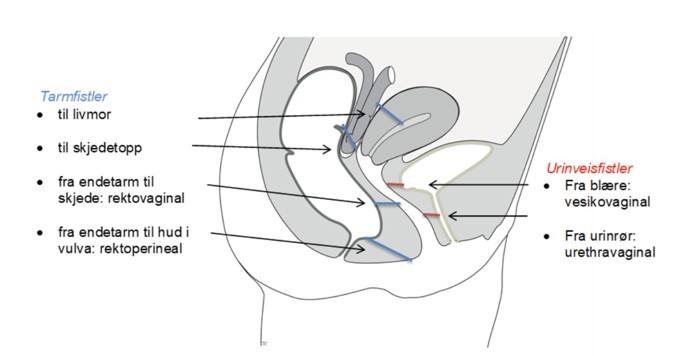 Bildet er en skisse av en kvinnes nedre del av bekken, og viser hvor fistler kan oppstå. Tarmfistler kan oppstå fra tarm til livmor, fra tarm til skjedetopp, fra endetarm til skjede, fra endetarm til hud i vulva. Urinveisfistler kan oppstå fra blære til skjede, og fra urinrør til skjede.